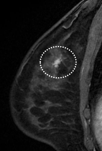 사진 - MRI에서 발견된 재발 유방암