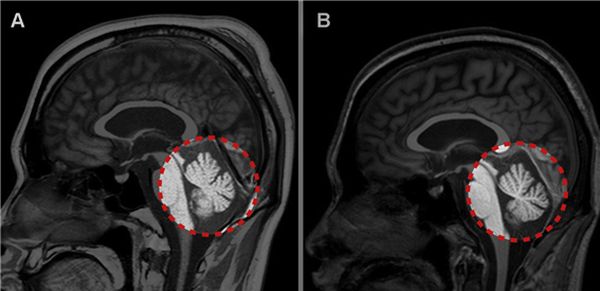그림. 지연성 어지럼증 환자의 MRI 검사를 통해 소뇌의 위축이 확인됐다. 내원 초기의 MRI 사진(A)과 비교해, 2개월 후 추적검사의 MRI 사진(B)에서 소뇌가 위축된 모습을 보이고 있다.