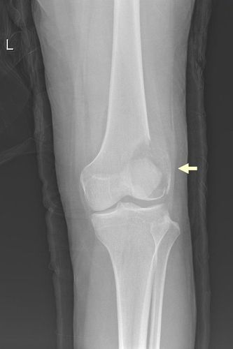 사진 : 관절주변 뼈에 발생한 거대세포종(X-ray 사진)