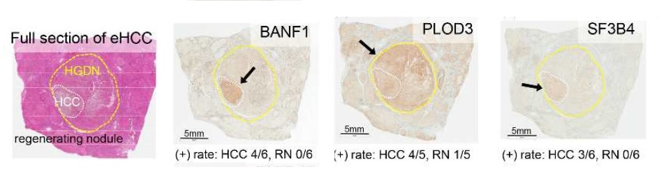 간암환자 조직으로부터 ‘BANF1, PLOD3, SF3B4’가 유의미하게 발현한 것으로 확인되었다.