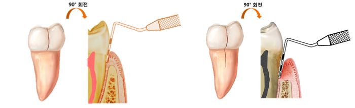 그림설명 - (좌측)crack이 치관부 (치아머리)에만 한정된 경우 - 치주낭깊이 3 mm 이내로 측정됨, 치수괴사 빈도 낮음, (우측)crack이 치근부 (치아뿌리)로 진행된 경우 - 치주낭깊이 4mm 이상으로 측정됨, 치수괴사 빈도 상대적으로 높음)