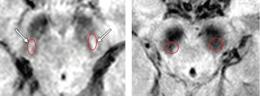 정상 렘수면행동장애환자(좌)와 파킨슨병 예견되는 렘수면행동장애환자(우) 뇌 MRI 이미지 비교