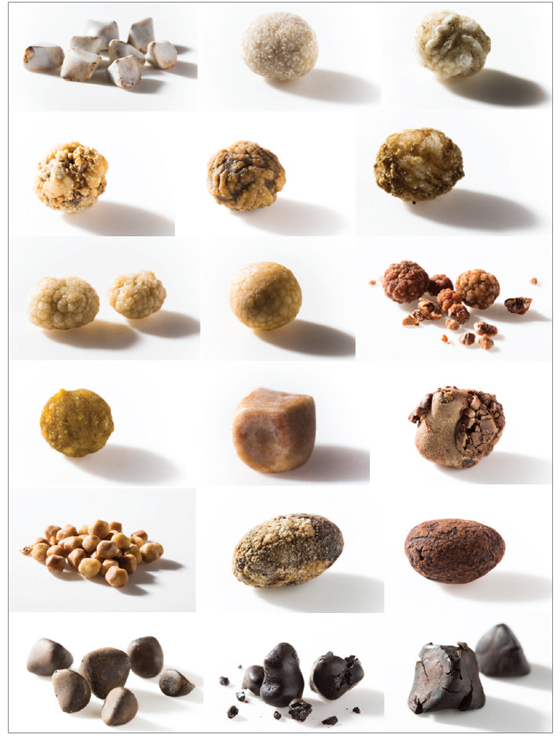 ▲ 그림 1. 다양한 담석의 형태 (Various types of gall stones)