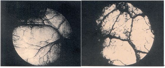 ▲ 그림 7,8. Ringleb의 촬영내시경으로 찍은 방광점막 사진. 정맥과 동맥이 자세히 보인다.