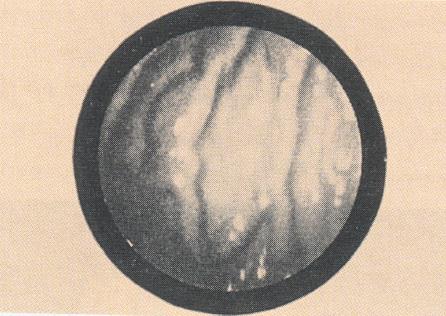 ▲ 그림 12. 뚜렷하게 irregular longitudinal gastric fold를 보여주는 흑백사진