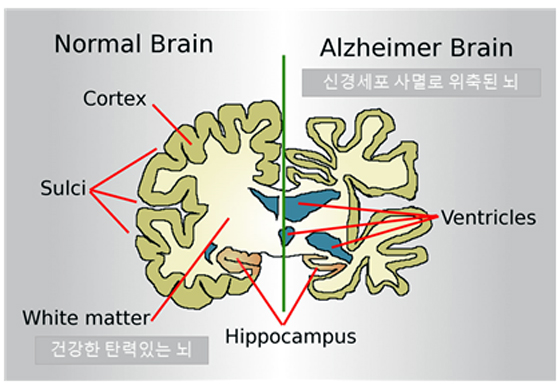 ▲ 그림 1. Comparison of Normal brain and Alzheimer’s brain. / 출처 : Neuroscience, May 2, 2011