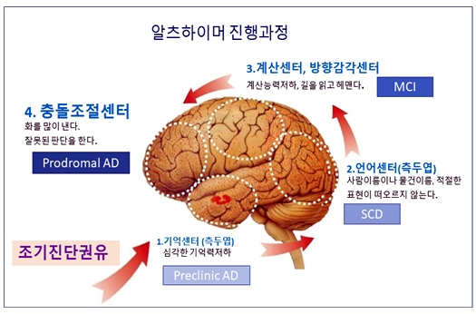 ▲ 그림 4. Progress of Alzheimer's dementia / 출처 : m.blog.naver.com/PostView.nhn?blogId=vhtpqms7&logNo