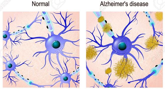 ▲ 그림 5. β-Amyloid plaques in Alzheimer’s brain / 출처 : https://nl.123rf.com/photo_74087894
