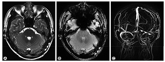 ▲ Fig. 1. Initial brain MRI of patient. T2-weighted (A) and gradient echo (B) images showed thrombus in left transverse sinus. Venogram (C) showed non-visualization of left transverse sinus at the first attack.