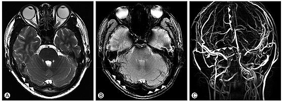 ▲ Fig. 2. Brain MRI at recurrence. T2-weighted (A) and gradient echo (B) images showed thrombus in right transvers sinus. Venogram (C) showed non-visualization of the right transverse sinus and superior sagittal sinus, which were different from initial venogram.