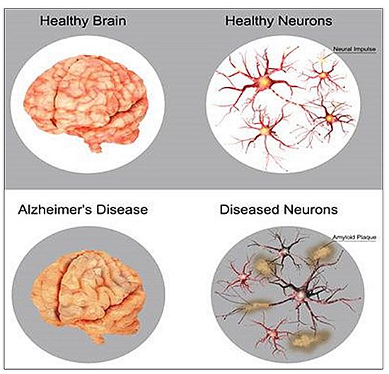 ▲ 그림 5. Healthy brain and Alzheimer’s brain./ 출처: nl.123rf.com/photo_66827292_de-patient-en-de-hersenen-gezonde-hersenen-en?neuronen- vergeleken-ziekte-van-alzheimer-amyloide-plaques-.html?fromid=NDlEUWxLbWdmY25wa2dJK1VKRm5jZz09