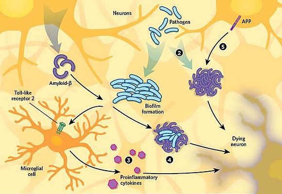 ▲ 그림 2. Several hypotheses to between infection and Alzheimer’s neurodegeneration pathology.  출 : The Scientitis, Sept., 1, 2017