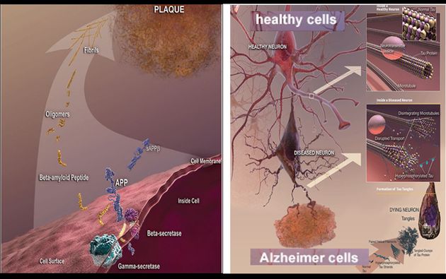 그림 1. Normal cells and Alzheimer’s.출처: National Institute of Aging, NIH publication number: 08-3782(September 2008)