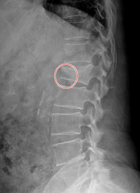 골다공증성 척추압박골절환자의 엑스레이 영상