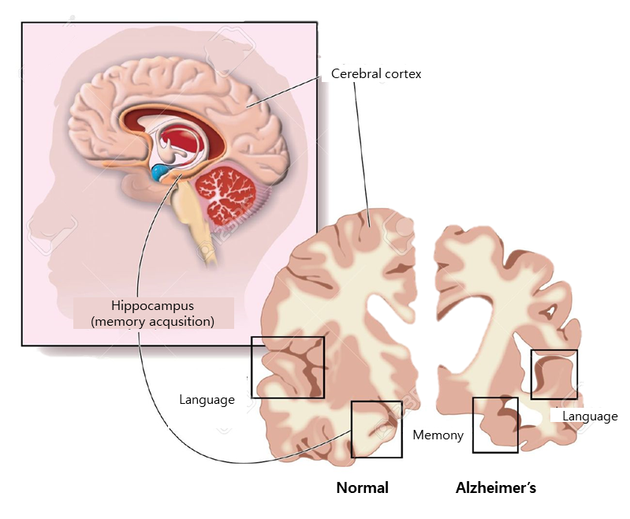 그림 1. Regions of the Hippocampus and Brain in Alzheimer’s Disease./ 출처: https://kr.123rf.com/photo_13842536_