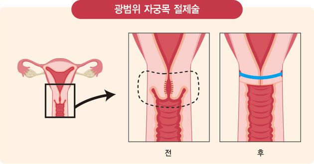 광범위 자궁목 절제술 설명