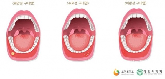 피곤하면 입병이 자주 나는 이유는?